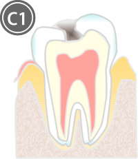 C1:エナメル質内の虫歯