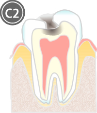 C2:象牙質に達した虫歯