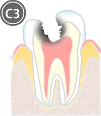 C3：歯髄(神経)に達した虫歯