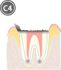 C4:歯質が失われた虫歯