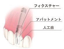 インプラントのメリット