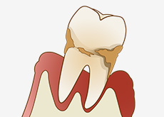 歯周病治療
