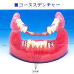 快適な入れ歯②