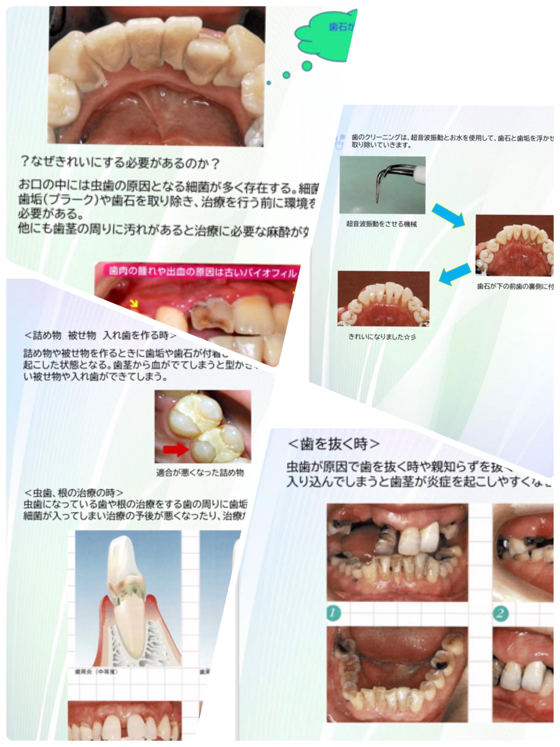 治療前に歯のクリーニングを！